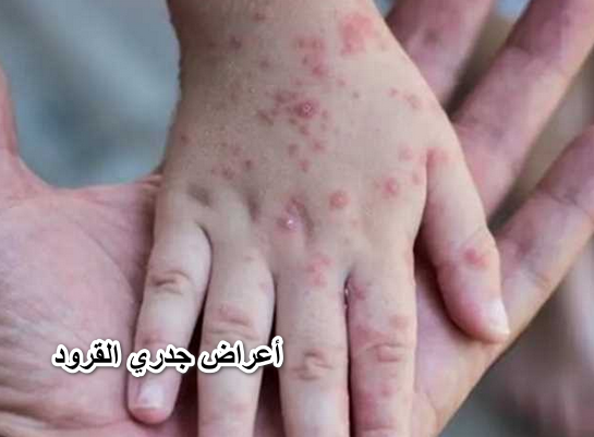 أعراض جدري القرود.. الأطفال والحوامل أكثر عرضة للإصابة