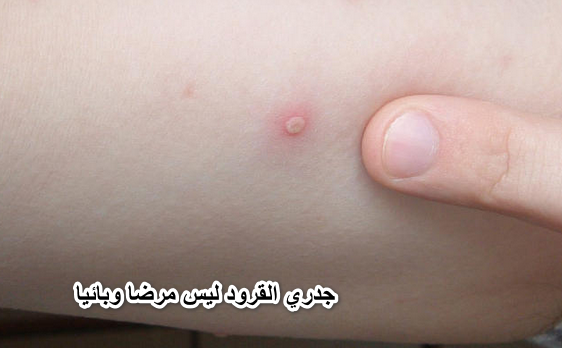 الصحة تطمئن المواطنين: جدري القرود ليس مرضا وبائيا